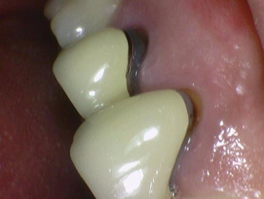 광화문 연세 예감 치과 해외에서도 찾아오는 지르코니아크라운 치료 안내해드려요 관련 이미지 18