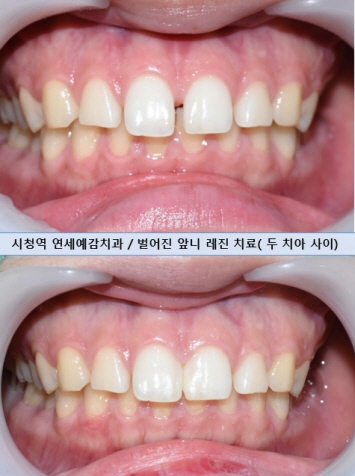 앞니사이벌어짐, 레진으로 메울 수 있을까? 비용,가격까지. 종로치과/광화문 치과 관련 이미지 4