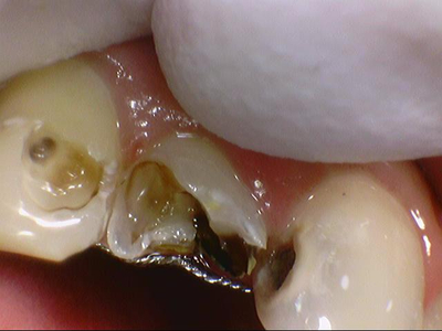 시청역치과 심한 (앞니)충치 치료방법 전후 사례 살펴보아요 관련 이미지 6