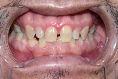 외국인환자의 왜소치 및 치아사이 공간으로 인한 서울 무삭제 라미네이트 & 최소삭제라미네이트 6개 케이스 치아전후사진 이벤트비용 관련 이미지 4