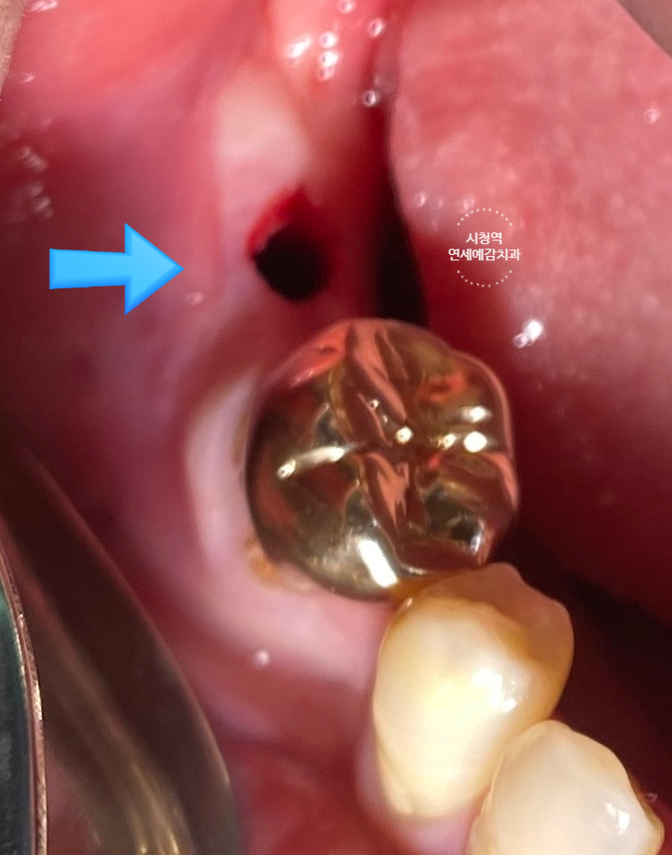 서울역 서울시청역 내비게이션인플란트 유명한 치과 관련 이미지 8