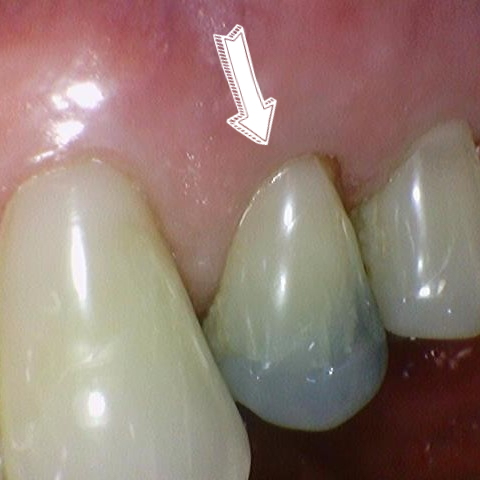 시청역치과, 신경치료 하고 크라운 꼭 해야하나요? 관련 이미지 3