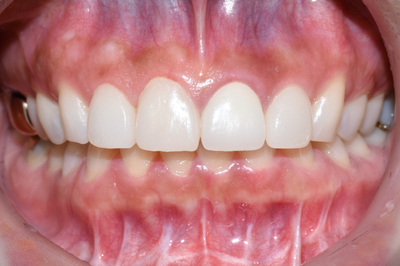 [시청역/광화문]라미네이트케이스:"치아가 작아서 옹졸해 보여요. 치아가 길어보이면 좋겠어요" 관련 이미지 6