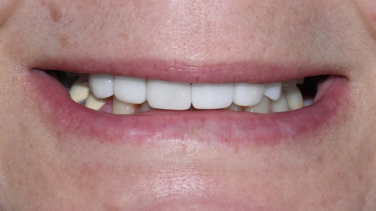 치아를 하얗게 하고 싶은 캐나다에서 오신 환자분의 라미네이트 사진공개이벤트진행중 관련 이미지 5