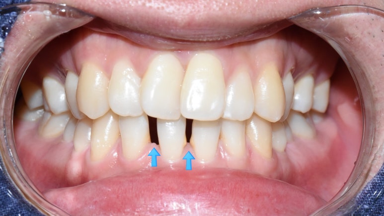 "아래 앞니 벌어진 틈 레진 하고 싶어요" &rarr;치료후 "(감쪽같아서) 어디를 했는지 모르겠어요" 관련 이미지 7