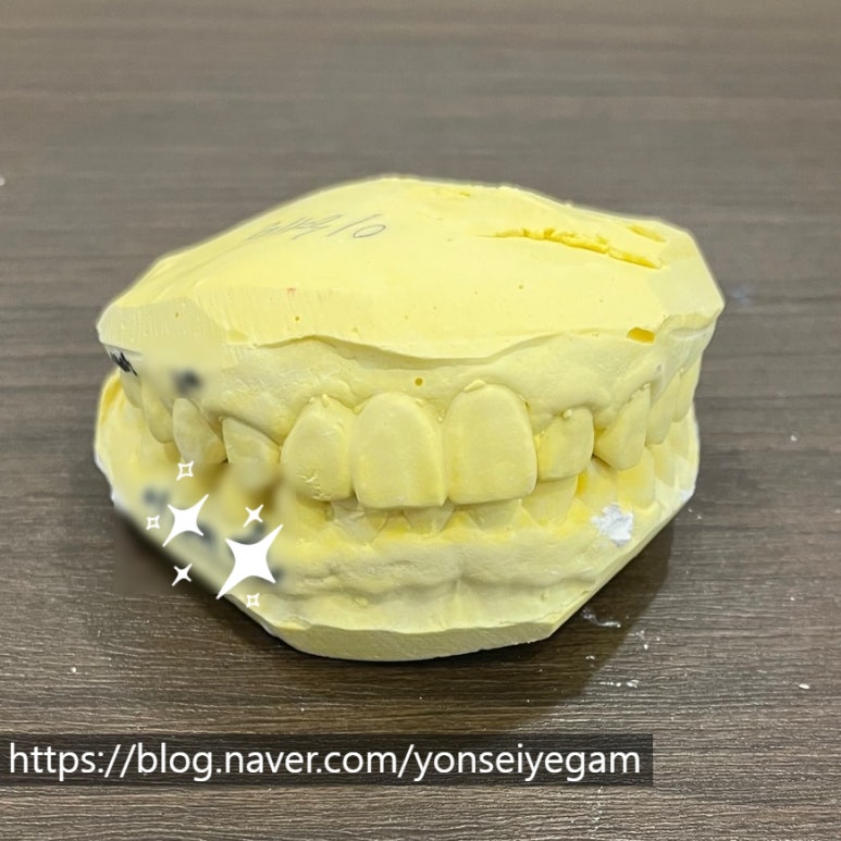 이갈이가 있다면? 이갈이 장치, 그냥 인터넷으로 사서 해도 되나요?/치과 이갈이장치 비용안내 관련 이미지 1