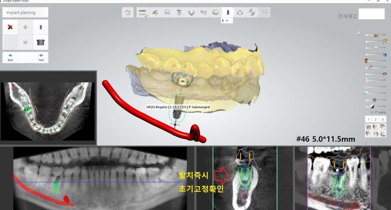 [북창동 치과/연세예감치과]내비게이션임플란트소개 관련 이미지 8