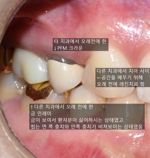 시청역치과/ "금니크라운이 보기싫은데 바꿀 수 있나요?" 관련 이미지 7