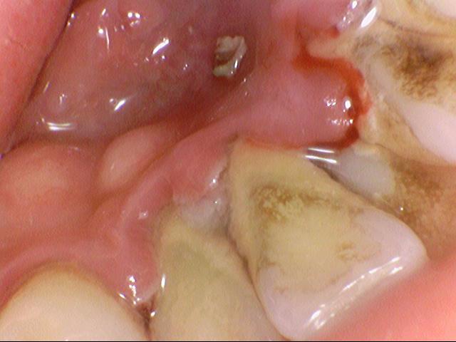 시청역/을지로 치과 가글마취 스케일링 가능해요! (+스켈링 소리동영상) 관련 이미지 2