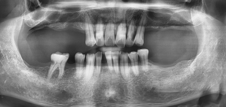 [치과브릿지케이스] 앞니가 너무 많이 흔들려서 발치해야 할 것 같아요 관련 이미지 2