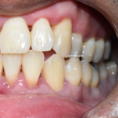 서울시청역 외국인환자 잇몸치료 전후 일주일만에 변화된 사진 관련 이미지 2