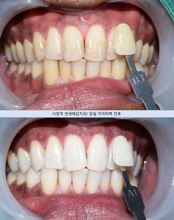 서울시청 용산 치아미백 잘 하는 치과, 예비신랑신부, 외국인, 교포들이 일부러 치아미백하러 찾아오는 치과 관련 이미지 6