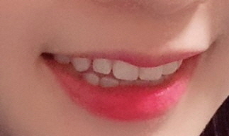 서울시청역치과/ 벌어진 앞니 치아 치료/ 왜소치, 다이아스테마 등/레진, 라미네이트, 부분교정 비교 관련 이미지 29