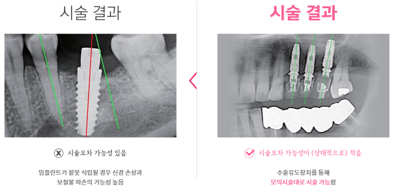 디지털임플란트 실제사례 알아보아요 관련 이미지 2