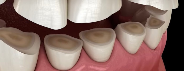 이갈이로 인한 치아 닳음 치료방법 비용 알아보아요 관련 이미지 1