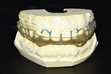 [서울/시청역] 이갈이소리녹음,이갈이장치소개, 이갈이치료방법, 가격 관련 이미지 3