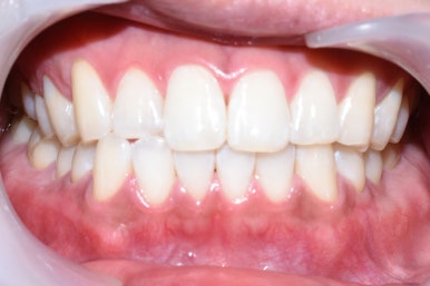 치아미백, 치과에서 하면 얼마나 오래갈까? 궁금하시다면, 실제사례 바탕으로 알아보아요 지속,유지 관련 이미지 4