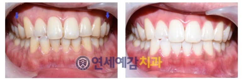 커피많이드세요? 치과에서 하는 치아미백 알려드려요[효과, 유지 등등 실제사례] 관련 이미지 2
