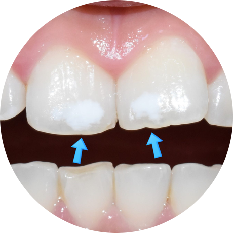 반점치, 반상치, 치아에 하얀 점 치료방법 전후사진, 가격 비용까지 관련 이미지 2