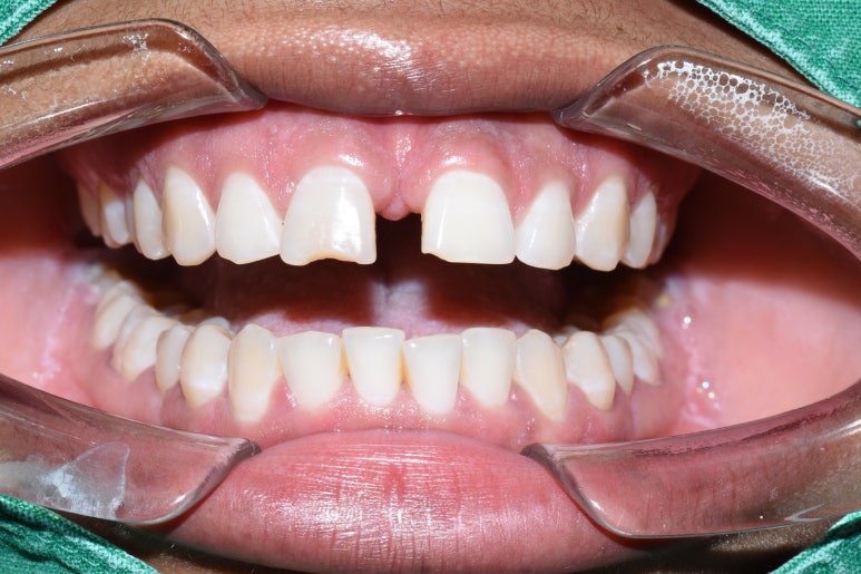 벌어진 앞니 치료, 하루에 가능, 실제케이스 및 가격 비용 관련 이미지 7