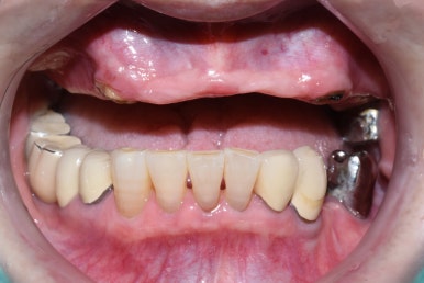 앞니 여러개 임플란트 잘하는 치과 서울역치과 실제사진 관련 이미지 23