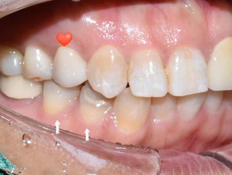 [서대문/광화문]외국인도 찾아오는 치아색나는 크라운, 지르코니아 크라운 치료 치과 어떻게 변하는지 확인해보아요 관련 이미지 2