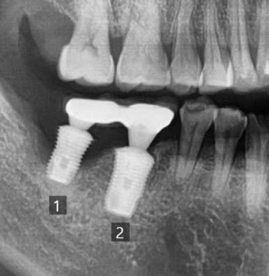 오래된 임플란트가 흔들려요 인플란트 재수술도 서울역가까운치과 연세예감치과 관련 이미지 15