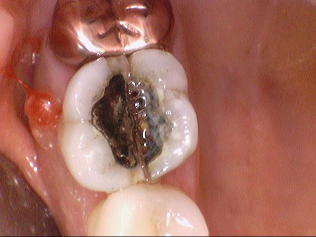 시청역 충정로 충치치료 치과 추천 관련 이미지 14