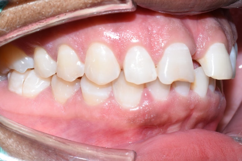 명동 가까운 치과 /외국인 흑인분의 매우 벌어진 앞니 치료 (빠른 부분교정(3개월)+라미네이트)/가격안내 관련 이미지 1