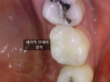[을지로가까운치과]아말감충치 치료사례 아말감 주변 2차충치를 레진/인레이/크라운으로 치료 관련 이미지 6