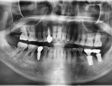 충정로 서울역 근처 고난도 & 재수술 임플란트 수술 치과 관련 이미지 7