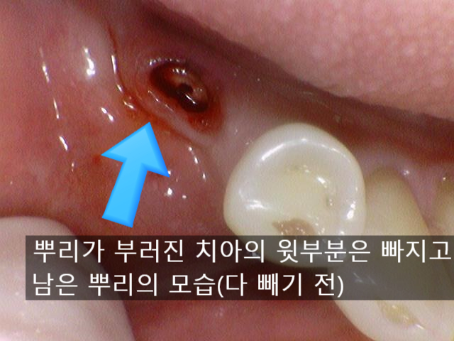 [서울역/치과] 고기 뼈를 씹고 치아가 부러졌어요 관련 이미지 5