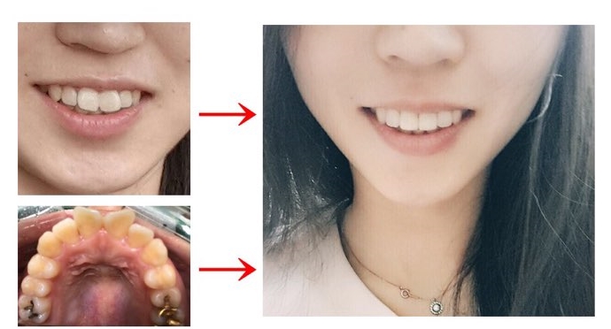 시청역치과 벌어진 앞니를 바르고 이쁘게! 대한심미학회회원치과 관련 이미지 1