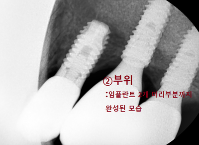 시청역 연세예감치과 임플란트여러개케이스(상악동거상+골이식+다수임플란트) 관련 이미지 6