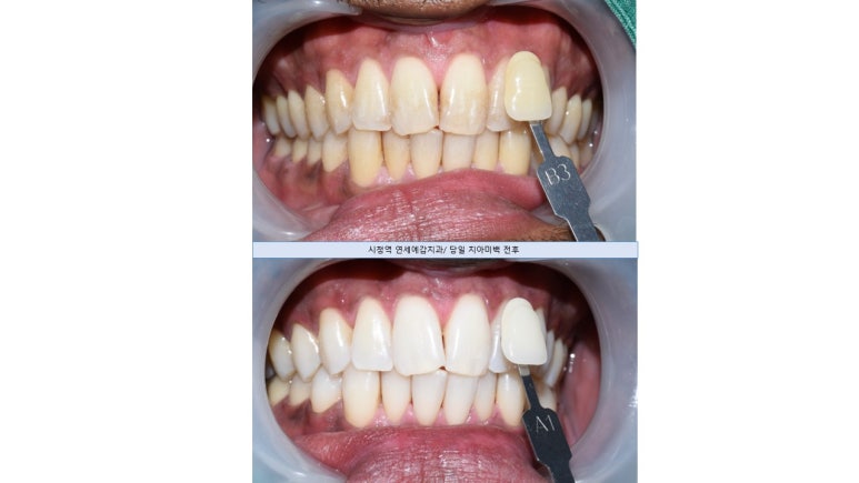[해외에서도 찾아오는 서울시청역/치과미백]커피를 많이 마셔서 치아가 착색이 됐어요. 치아미백?? 관련 이미지 2