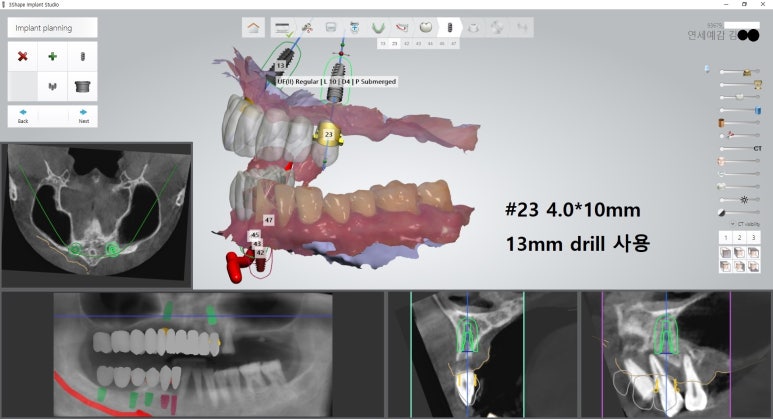 [북창동 치과/연세예감치과]내비게이션임플란트소개 관련 이미지 23