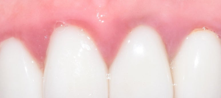 잇몸에서 피가 나요 잇몸치료에 대해 알려드려요 실제사례 및 비용은 관련 이미지 1