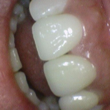 앞니 하나가 부러졌어요 앞니 크라운 앞니 브릿지 관련 이미지 6