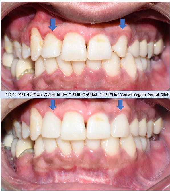 1.송곳니를 다른 앞니 모양 라미네이트로, 2.치아사이 빈공간을 라미네이트로 관련 이미지 7
