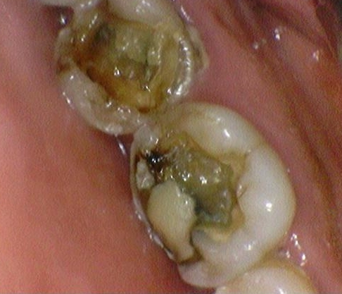 시청역치과/ "금니크라운이 보기싫은데 바꿀 수 있나요?" 관련 이미지 4