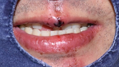 넘어져서 또는 부딪혀서 앞니 아주 많이 부러진 경우, 시청역치과 실제 앞니브릿지케이스 관련 이미지 3