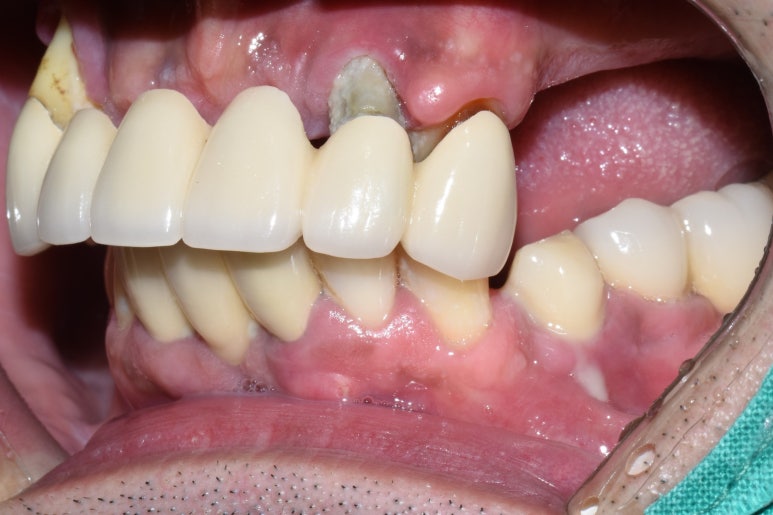 [임플란트/서울역] 서울 상악 전체인플란트 실제사례.극한의 케이스도 관련 이미지 4