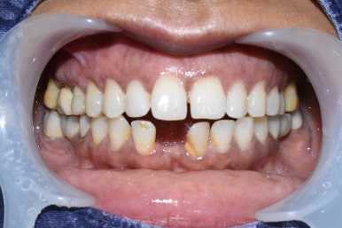 넘어져서 또는 부딪혀서 앞니 아주 많이 부러진 경우, 시청역치과 실제 앞니브릿지케이스 관련 이미지 15