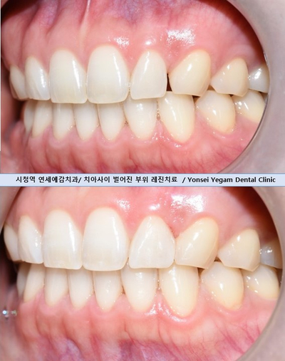 앞니사이벌어짐, 레진으로 메울 수 있을까? 비용,가격까지. 종로치과/광화문 치과 관련 이미지 8