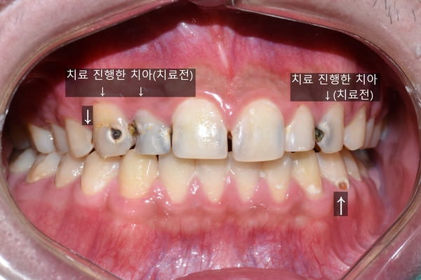 시청역치과 심한 (앞니)충치 치료방법 전후 사례 살펴보아요 관련 이미지 8