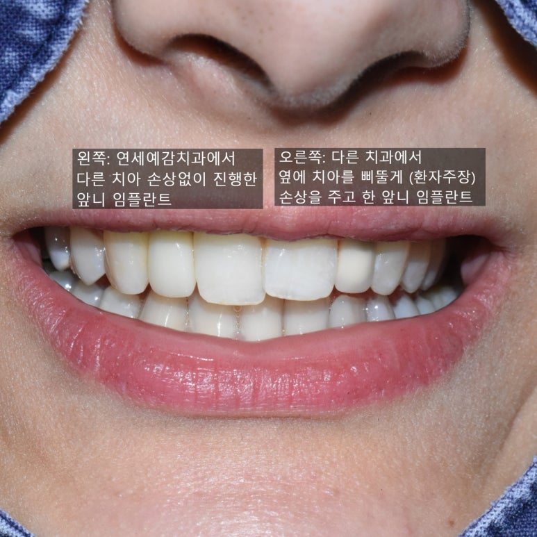 네비게이션임플란트 이용한 앞니 치료 유명한 치과 잔존 유치 케이스 관련 이미지 15