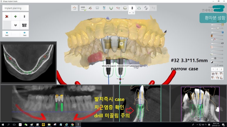 [시청역/을지로] 임플란트 진단 상담 비용? 관련 이미지 4