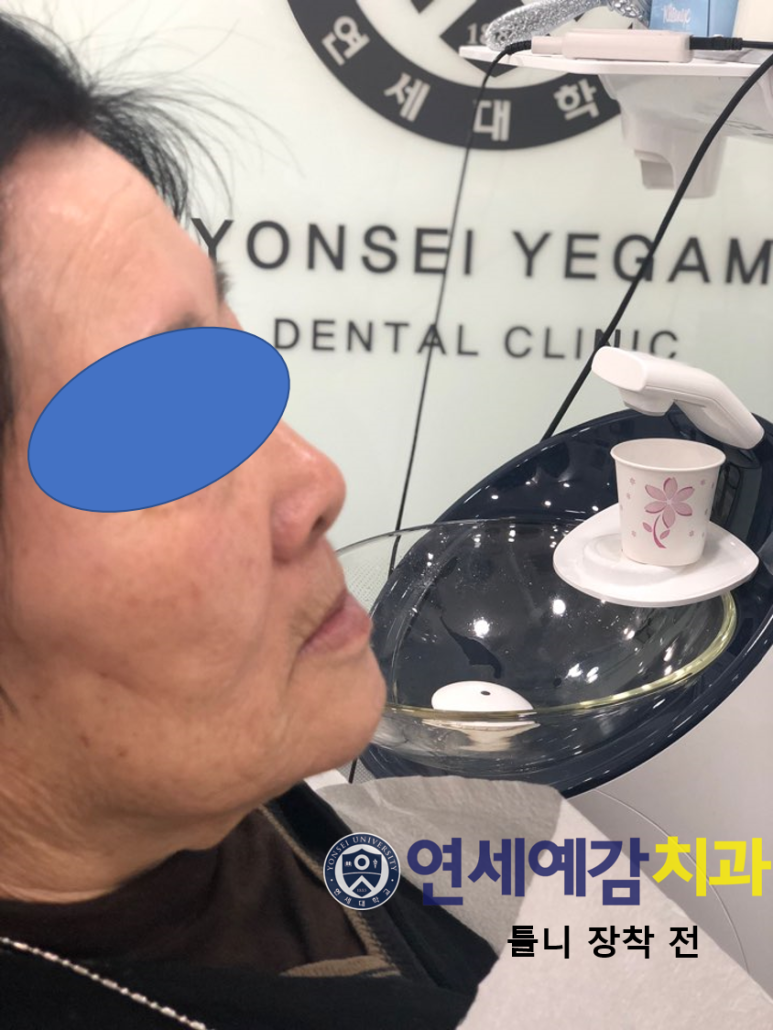 서울 틀니제작, 틀니치료 실제 예입니다. 시청역<연세예감치과> 관련 이미지 5