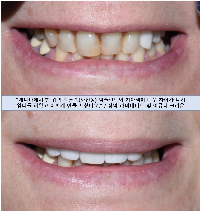 치아를 하얗게 하고 싶은 캐나다에서 오신 환자분의 라미네이트 사진공개이벤트진행중 관련 이미지 1