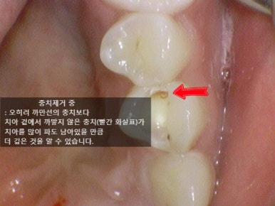 충정로 치과 인레이 해야한다고 들었는데 충치가 안보여요 관련 이미지 6